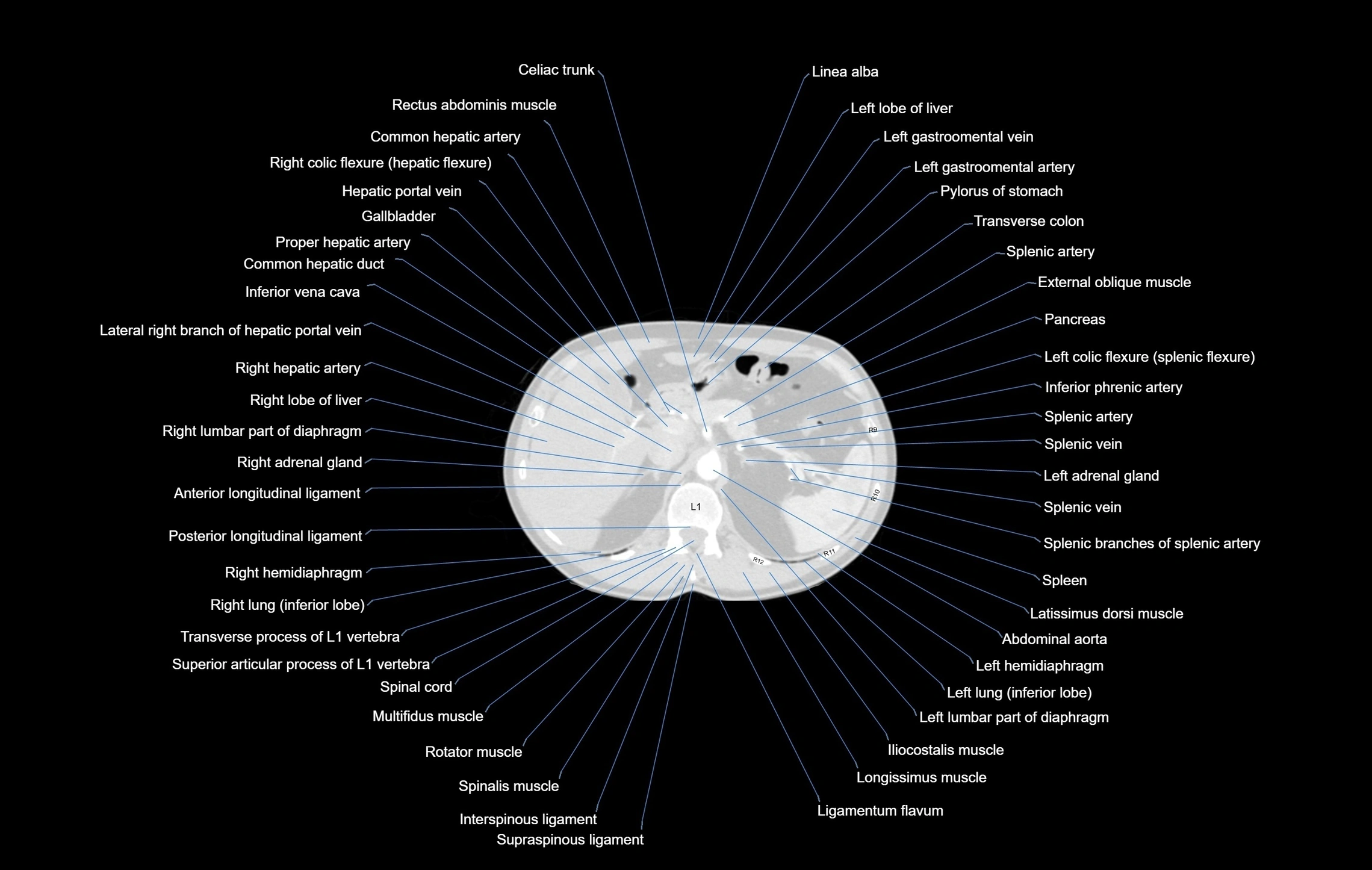 CT chest (thorax) labelled axial cross sectional anatomy radiology image-00121.webp